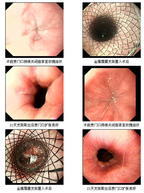 内镜下临时覆膜支架治疗贲门失弛缓症